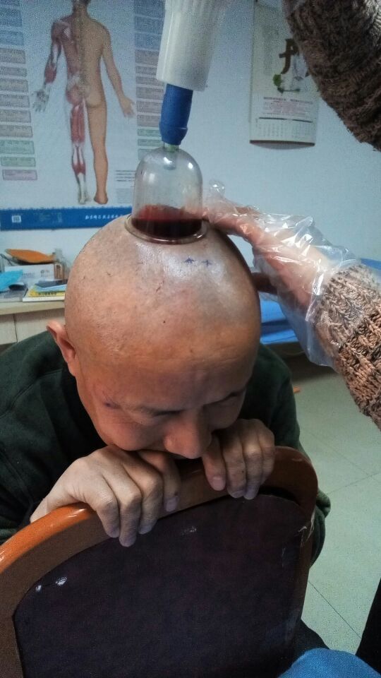 泻血疗法 学员实操给患者泻血治头痛!